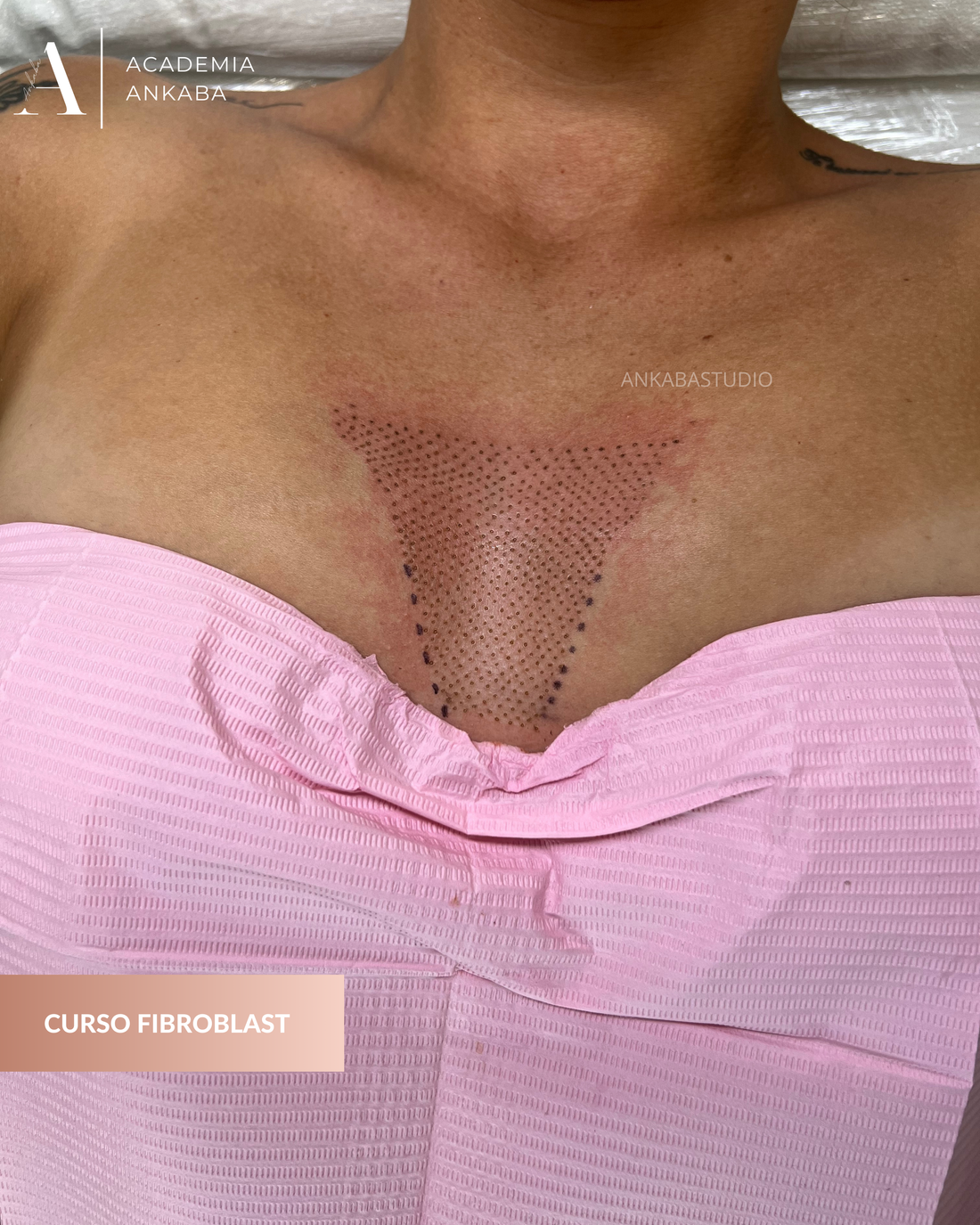 ”¿Qué es el Fibroblast y por qué es una revolución en la cosmetología?”
