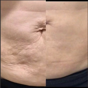 Fibroblast Corporal en Chile | Plasma Pen Rejuvenecimiento | Clínica Ankaba Estética & Salud