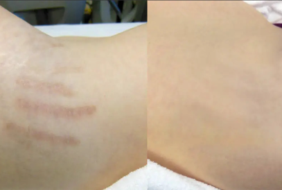 Fibroblast Corporal en Chile | Plasma Pen Rejuvenecimiento | Clínica Ankaba Estética & Salud