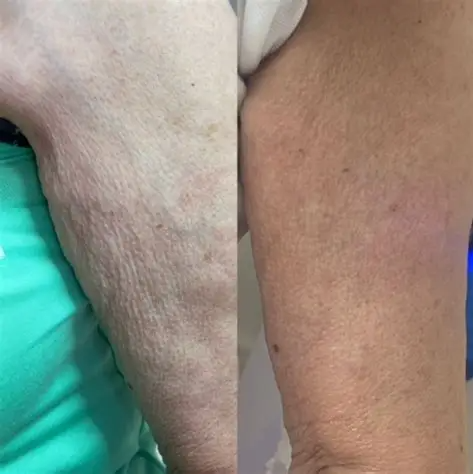Fibroblast Corporal en Chile | Plasma Pen Rejuvenecimiento | Clínica Ankaba Estética & Salud