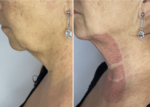 Fibroblast en Cuello y Escote en Chile | Plasma Pen Rejuvenecimiento | Clínica Ankaba Estética & Salud
