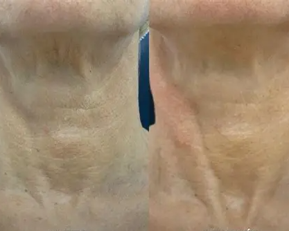 Fibroblast en Cuello y Escote en Chile | Plasma Pen Rejuvenecimiento | Clínica Ankaba Estética & Salud