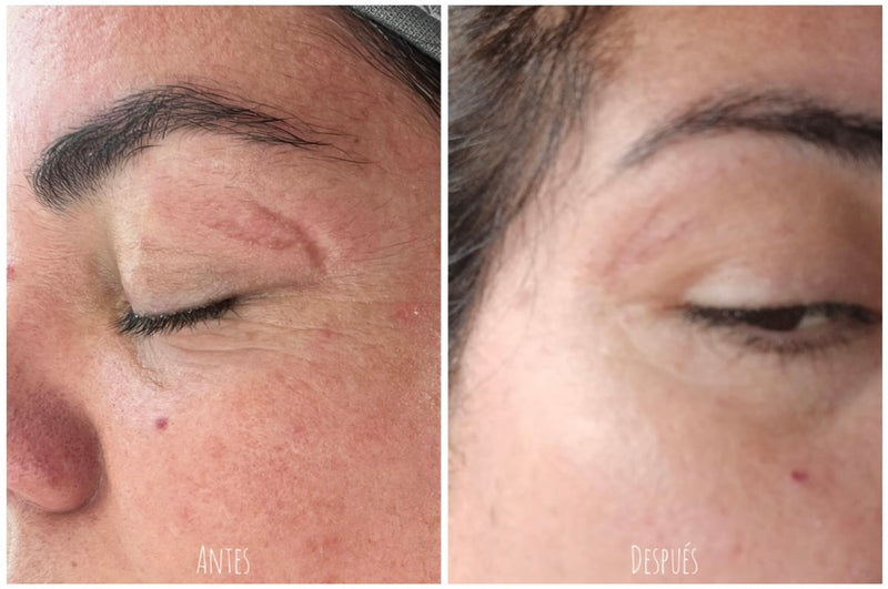 Fibroblast Facial en Chile | Plasma Pen Rejuvenecimiento del Rostro | Clínica Ankaba Estética & Salud