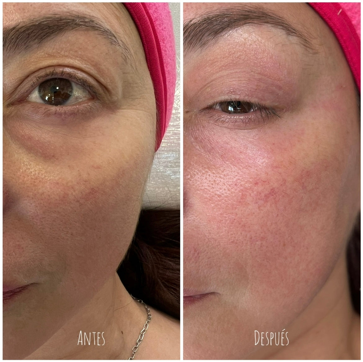 Fibroblast Facial en Chile | Plasma Pen Rejuvenecimiento del Rostro | Clínica Ankaba Estética & Salud