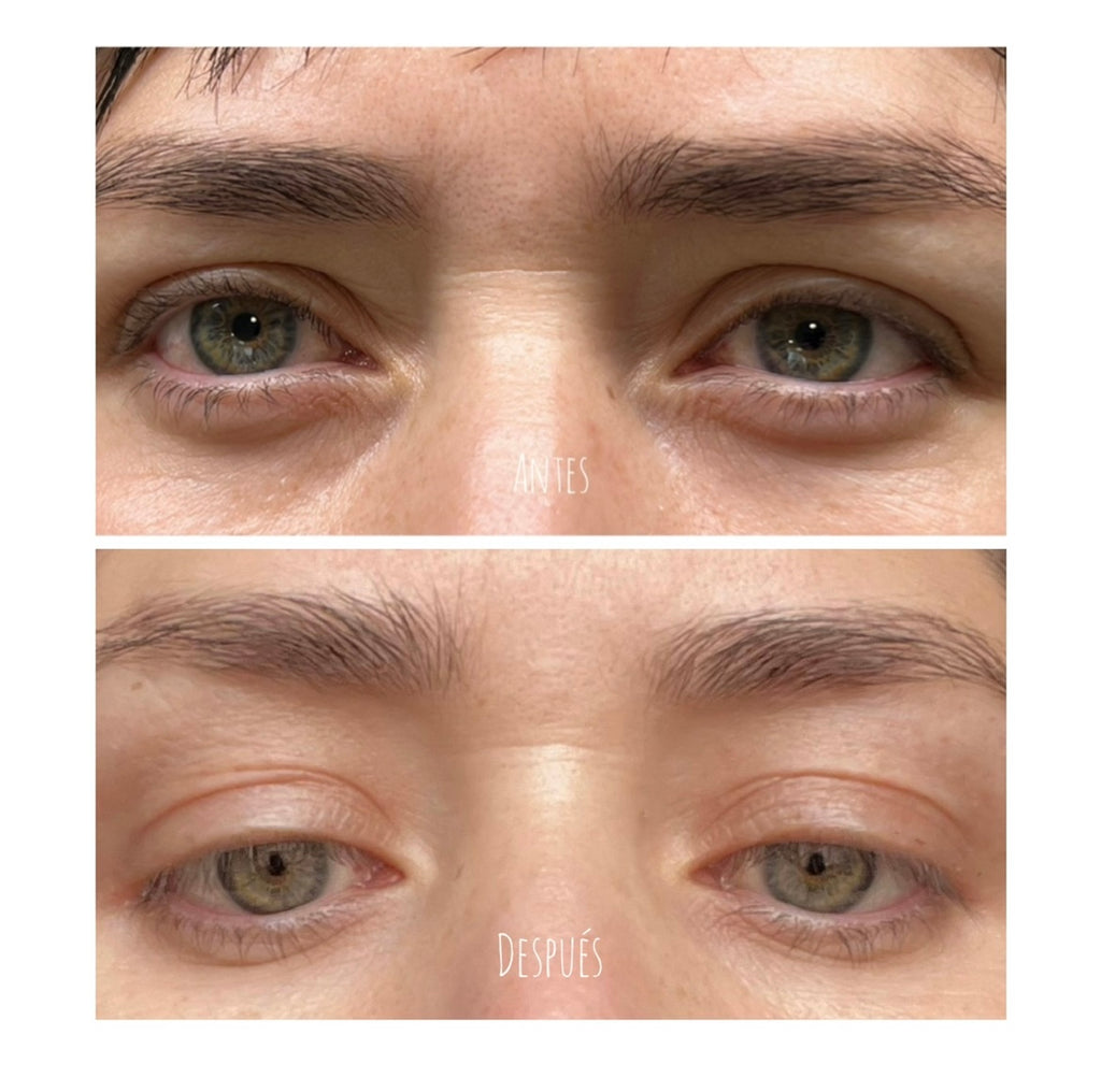 Fibroblast Facial en Chile | Plasma Pen Rejuvenecimiento del Rostro | Clínica Ankaba Estética & Salud
