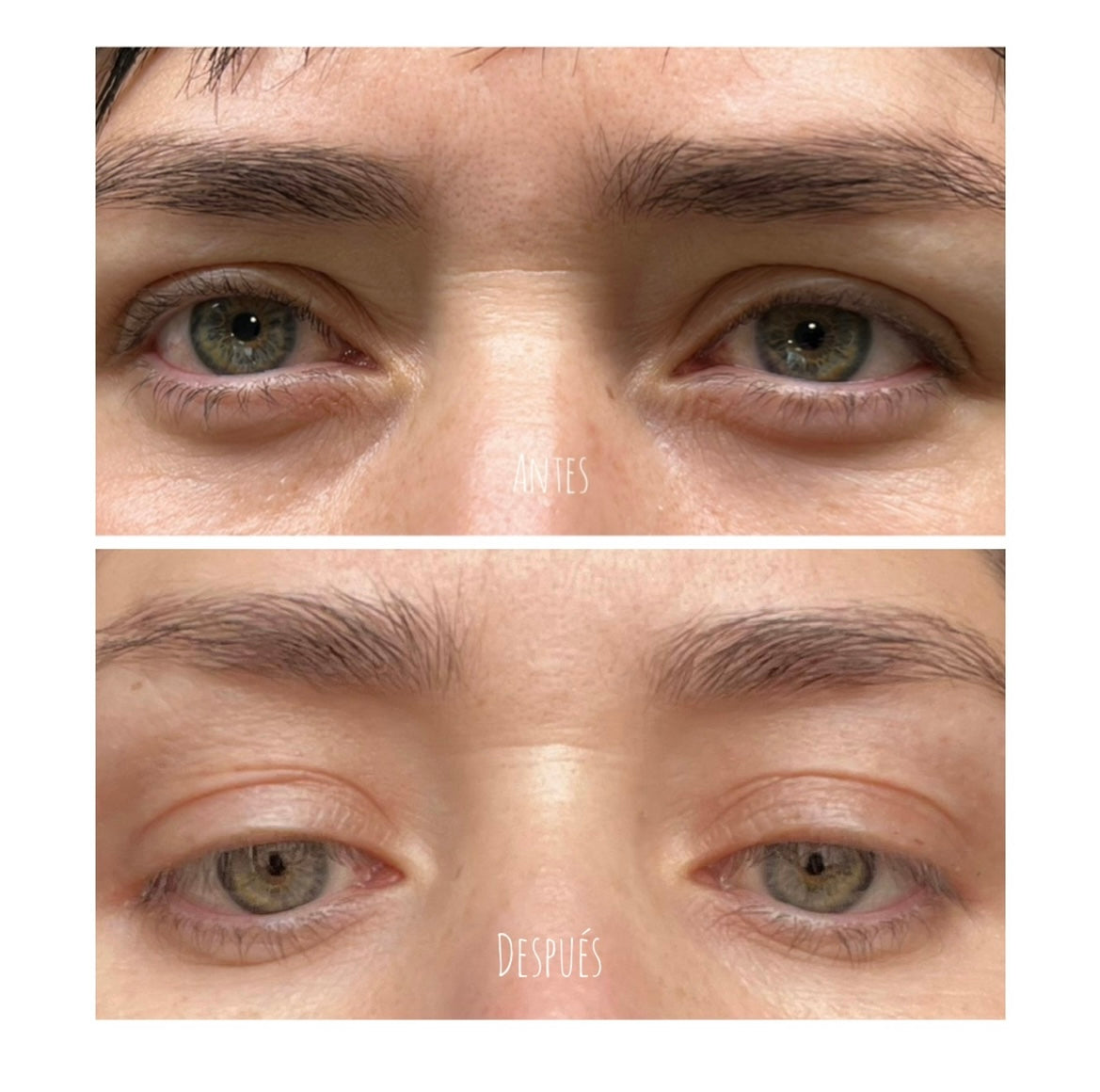 FIBROBLAST – CORPORAL