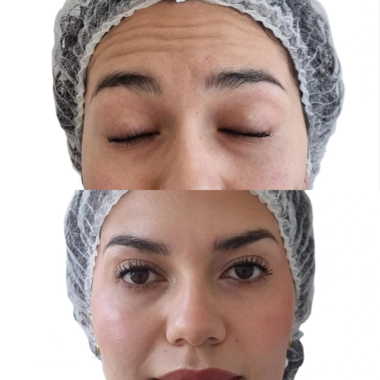 Bótox en Chile | Toxina Botulínica Facial Profesional | Clínica Ankaba Estética & Salud
