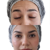 Bótox en Chile | Toxina Botulínica Facial Profesional | Clínica Ankaba Estética & Salud