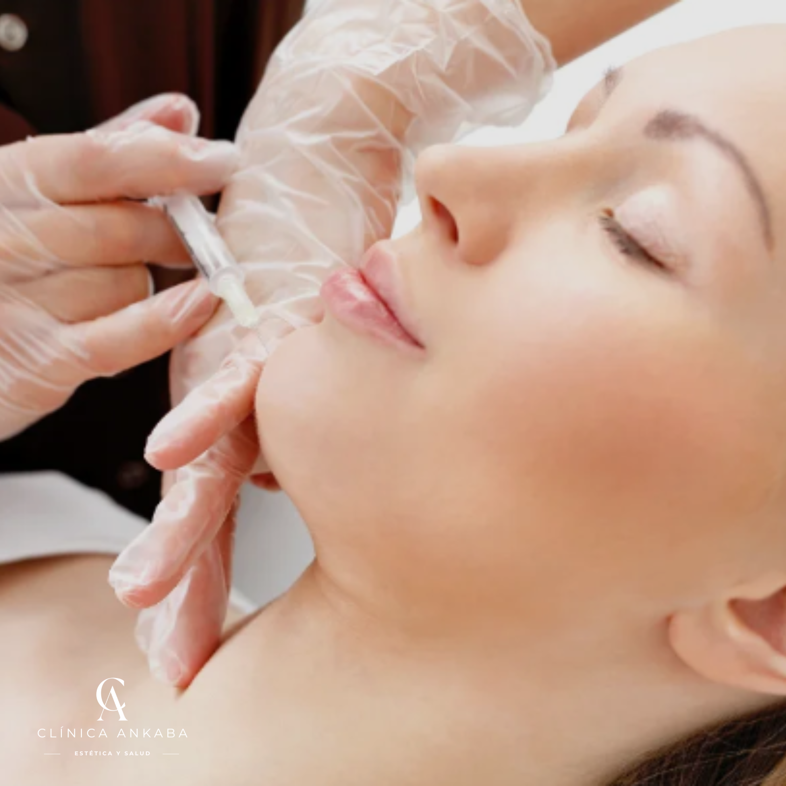 Proyección de Mentón con Ácido Hialurónico