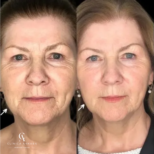 ADN de Salmón en Chile | Regeneración Facial con Polinucleótidos | Clínica Ankaba Estética & Salud