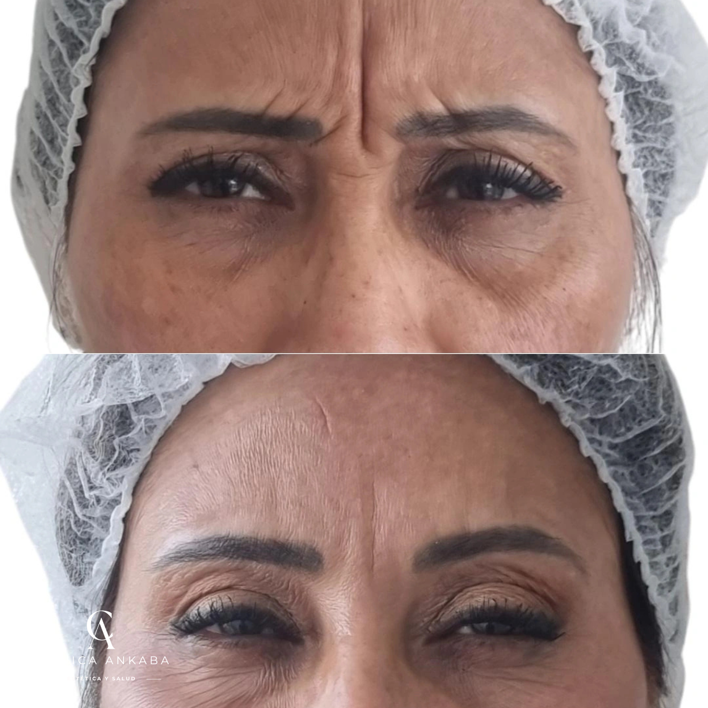 Bótox en Chile | Toxina Botulínica Facial Profesional | Clínica Ankaba Estética & Salud