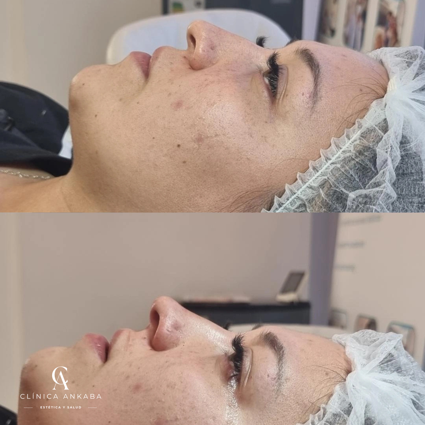 Rellenos con Ácido Hialurónico en Chile | Armonización Facial | Clínica Ankaba Estética & Salud