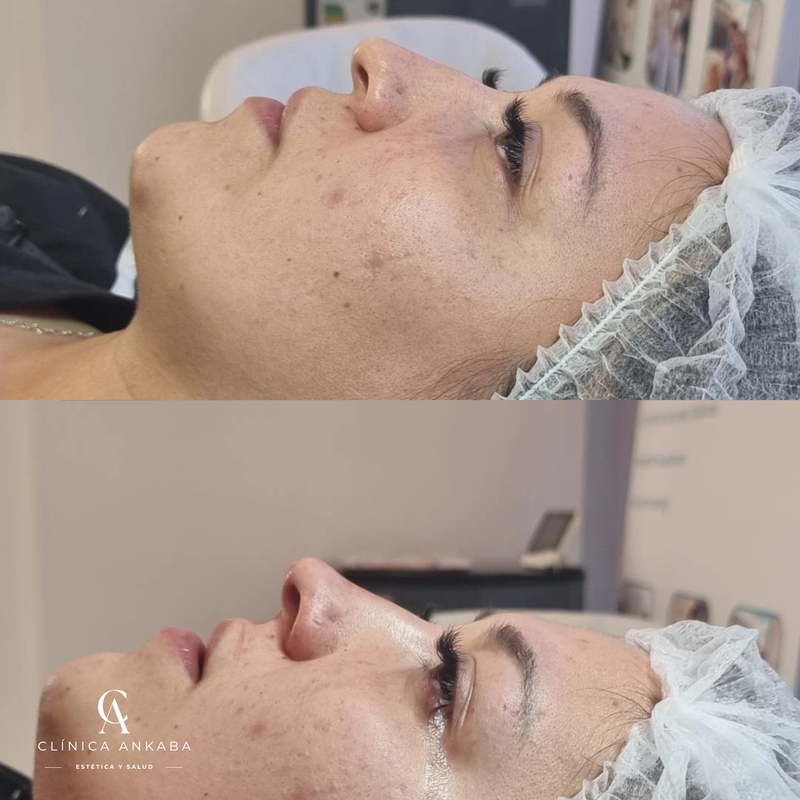 Rellenos con Ácido Hialurónico en Chile | Armonización Facial | Clínica Ankaba Estética & Salud