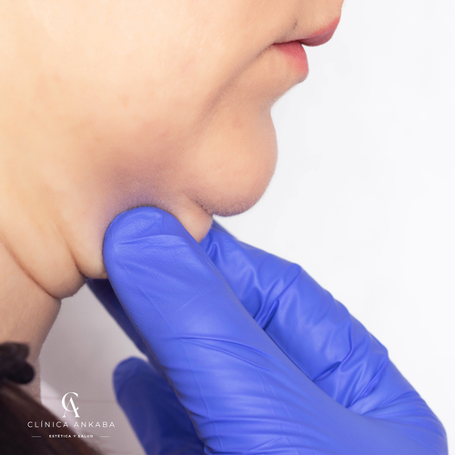 Adiós Papada – Enzimas Lipolíticas + Radiofrecuencia